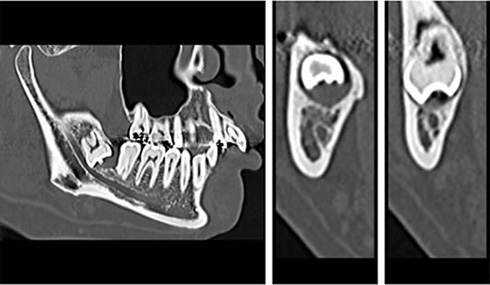 1）下歯槽管との立体的位置関係を容易に確認することができます。