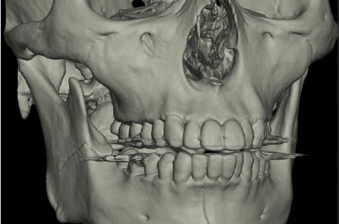 4）立体的な骨の状態を確認することができます。
