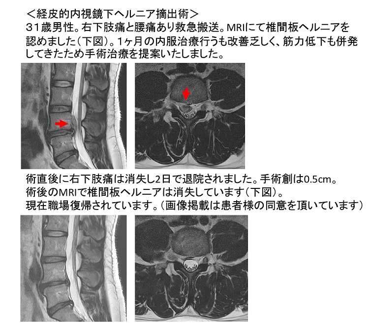 当院での経皮的内視鏡下ヘルニア摘出術を受けられた患者様の紹介