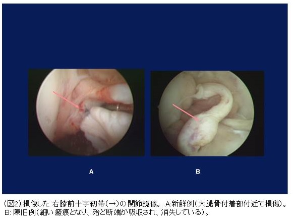 膝靱帯手術の全て