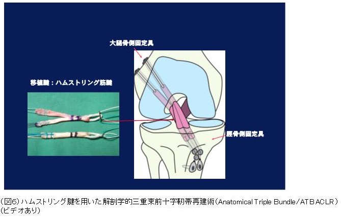 膝靱帯手術の全て