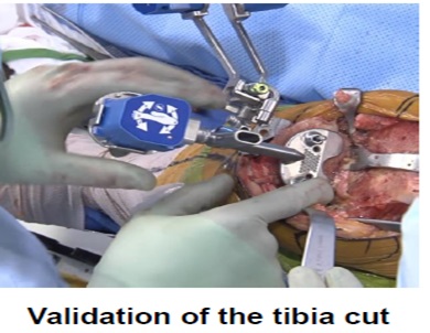 Validation of the tibia cut